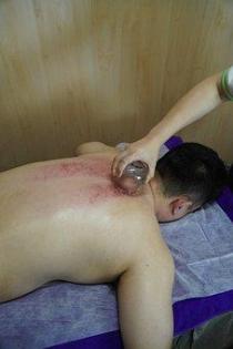 Jetzt auch Schröpfmassage bei Yan Lin in St. Gallen