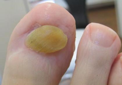 Nagelpilz Spuren am Nagel in 15 Min. mit dem Fußnagelspray von Jenn Cosmetic weg