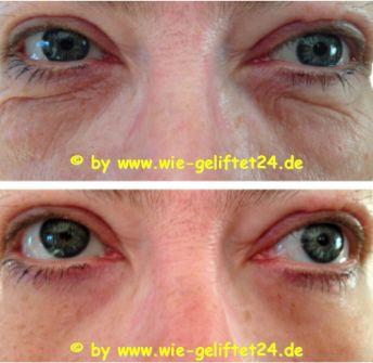 „Ultimate Young“ - Anti-Aging der neuen Art! Faltenfrei in wenigen Minuten