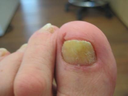 Nagelpilz Spuren am Nagel in 15 Min. mit dem Fußnagelspray von Jenn Cosmetic weg