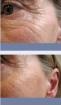 Faltenfrei ohne Spritzen, ohne Schmerzen, ohne Hormone !