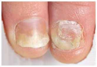 Nagelpilz effektiv  bekämpfen  aus Asien 